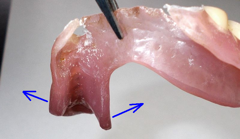 dentiera resina DSCN6441_2 frecce.JPG